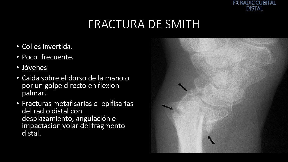 FX RADIOCUBITAL DISTAL FRACTURA DE SMITH Colles invertida. Poco frecuente. Jóvenes Caida sobre el