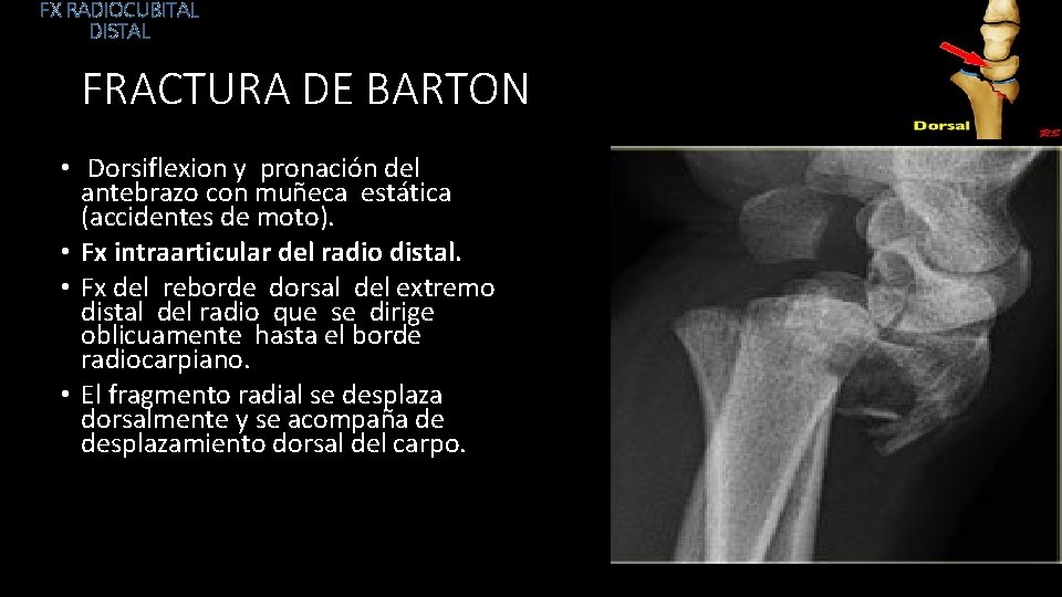 FX RADIOCUBITAL DISTAL FRACTURA DE BARTON • Dorsiflexion y pronación del antebrazo con muñeca