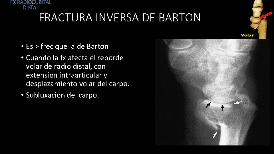 FX RADIOCUBITAL DISTAL FRACTURA INVERSA DE BARTON • Es > frec que la de