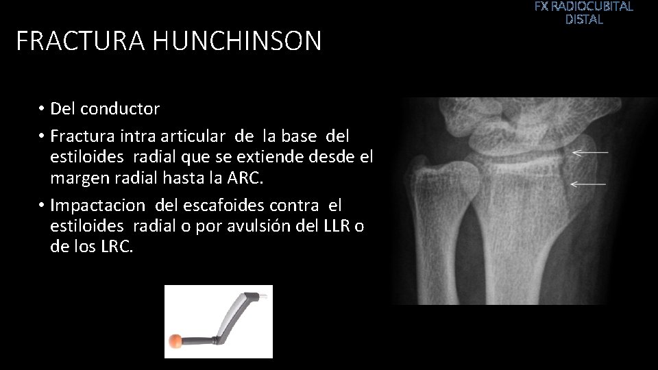 FRACTURA HUNCHINSON • Del conductor • Fractura intra articular de la base del estiloides