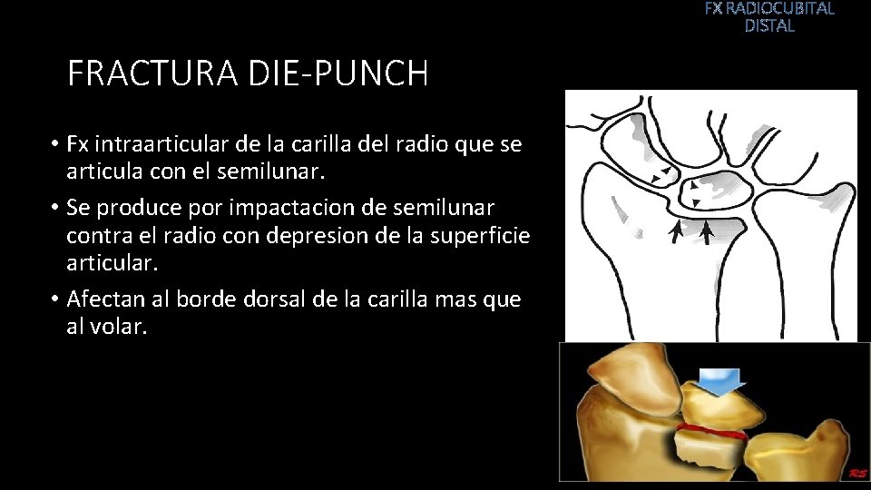 FX RADIOCUBITAL DISTAL FRACTURA DIE-PUNCH • Fx intraarticular de la carilla del radio que