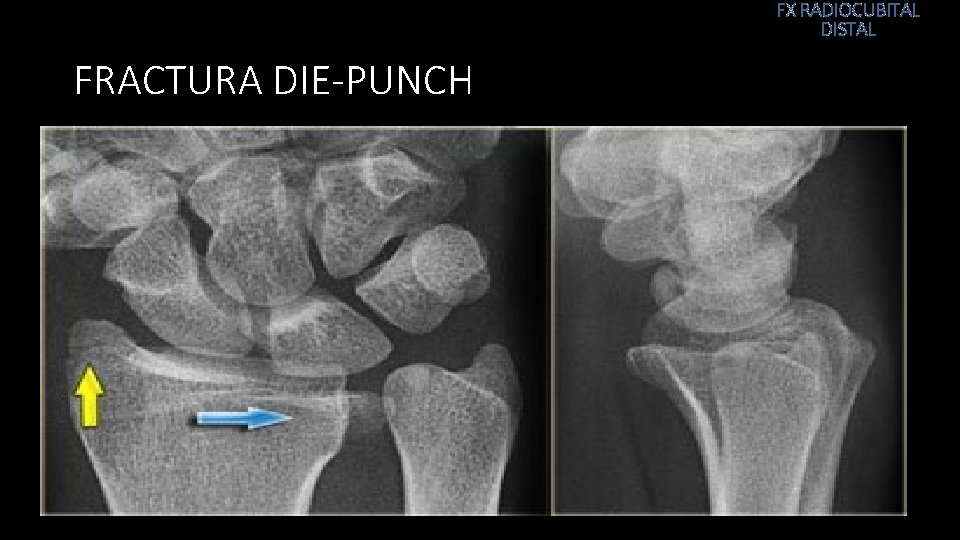 FX RADIOCUBITAL DISTAL FRACTURA DIE-PUNCH 