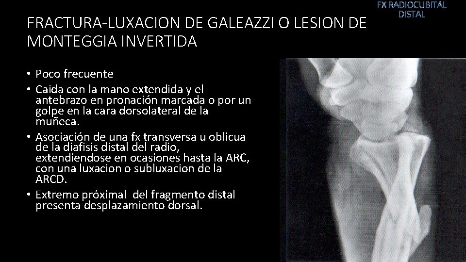 FRACTURA-LUXACION DE GALEAZZI O LESION DE MONTEGGIA INVERTIDA • Poco frecuente • Caida con