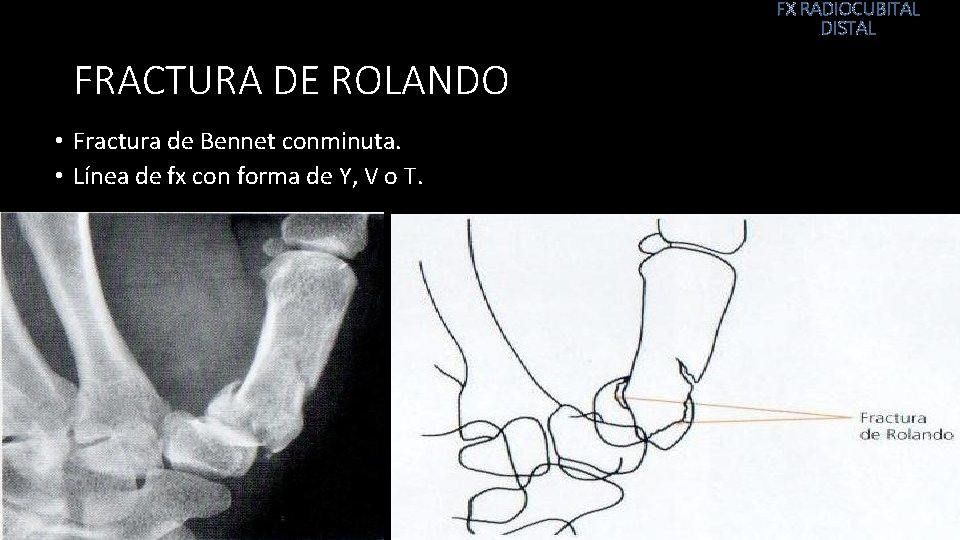 FX RADIOCUBITAL DISTAL FRACTURA DE ROLANDO • Fractura de Bennet conminuta. • Línea de