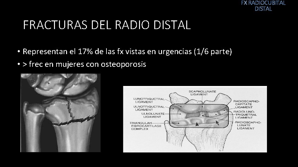 FX RADIOCUBITAL DISTAL FRACTURAS DEL RADIO DISTAL • Representan el 17% de las fx
