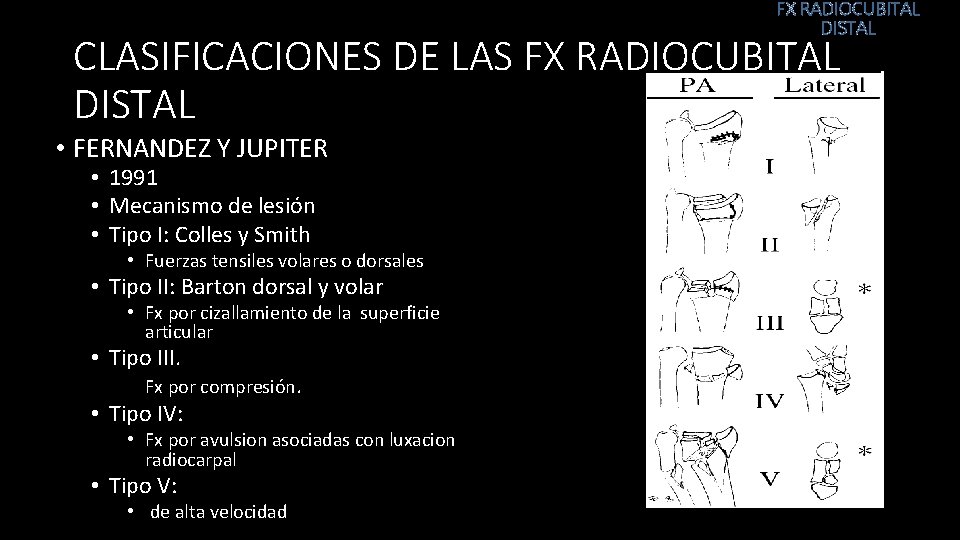 FX RADIOCUBITAL DISTAL CLASIFICACIONES DE LAS FX RADIOCUBITAL DISTAL • FERNANDEZ Y JUPITER •