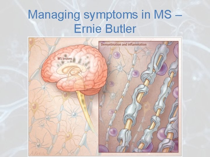 Managing symptoms in MS – Ernie Butler 