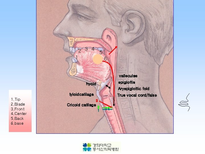 2 3 4 5 1 6 valleculae epiglottis hyoid Aryepiglottic fold tyloidcatilage 1. Tip