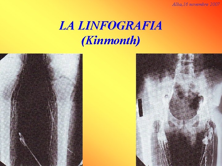 Alba, 16 novembre 2007 LA LINFOGRAFIA (Kinmonth) 