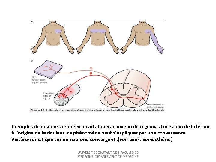 Exemples de douleurs référées : irradiations au niveau de régions situées loin de la
