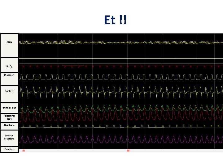 Et !! PWA Sp. O 2 Pression Airflow Thoracic belt Abdominal belt Heart rate