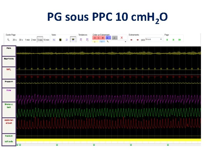 PG sous PPC 10 cm. H 2 O PWA Heart rate Sp. O 2