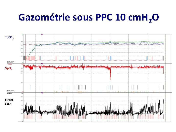 Gazométrie sous PPC 10 cm. H 2 O Tc. CO 2 Sp. O 2