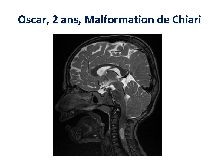 Oscar, 2 ans, Malformation de Chiari 