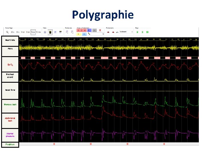 Polygraphie Heart rate PWA Sp. O 2 Tracheal sound Nasal flow Thoracic belt Abdominal