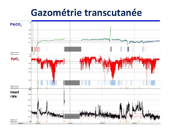 Gazométrie transcutanée Ptc. CO 2 Sp. O 2 Heart rate 