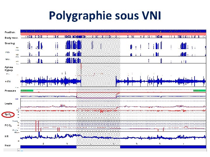 Polygraphie sous VNI Position Body mov. Snoring Apnea Hypop Pressure Leaks Sp. O 2