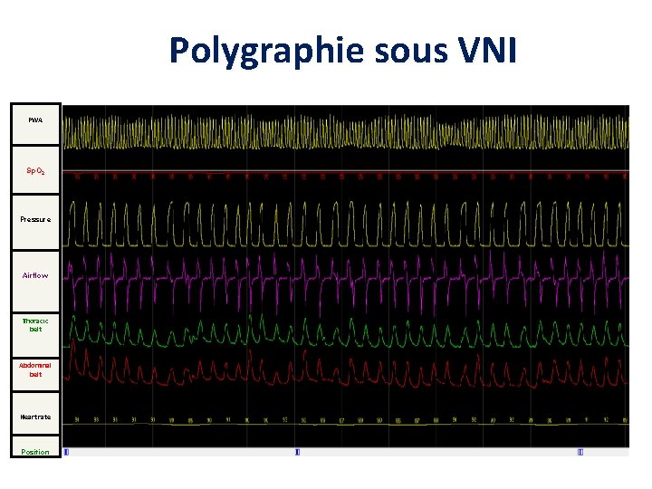 Polygraphie sous VNI PWA Sp. O 2 Pressure Airflow Thoracic belt Abdominal belt Heart