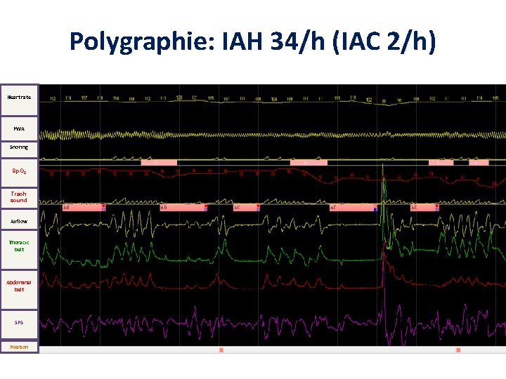 Polygraphie: IAH 34/h (IAC 2/h) Heart rate PWA Snoring Sp. O 2 Trach sound