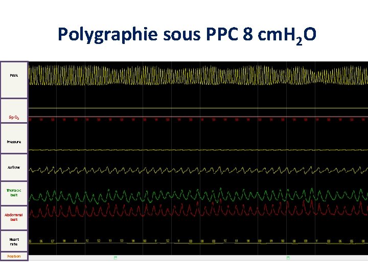 Polygraphie sous PPC 8 cm. H 2 O PWA Sp. O 2 Pressure Airflow