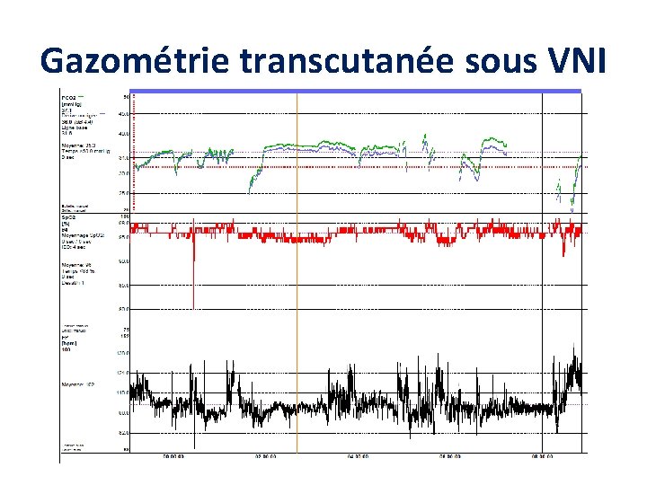 Gazométrie transcutanée sous VNI 