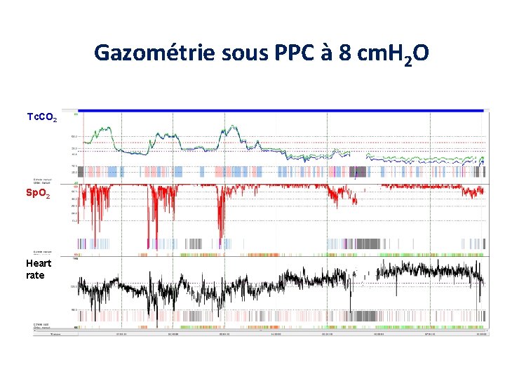 Gazométrie sous PPC à 8 cm. H 2 O Tc. CO 2 Sp. O