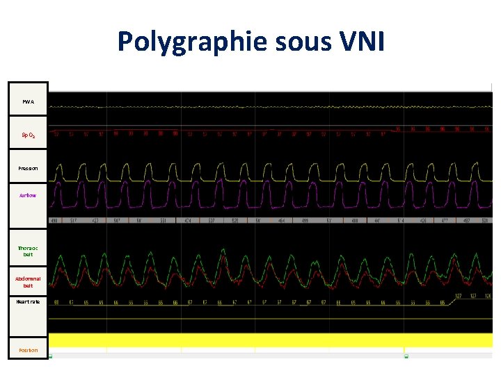 Polygraphie sous VNI PWA Sp. O 2 Pression Airflow Thoracic belt Abdominal belt Heart