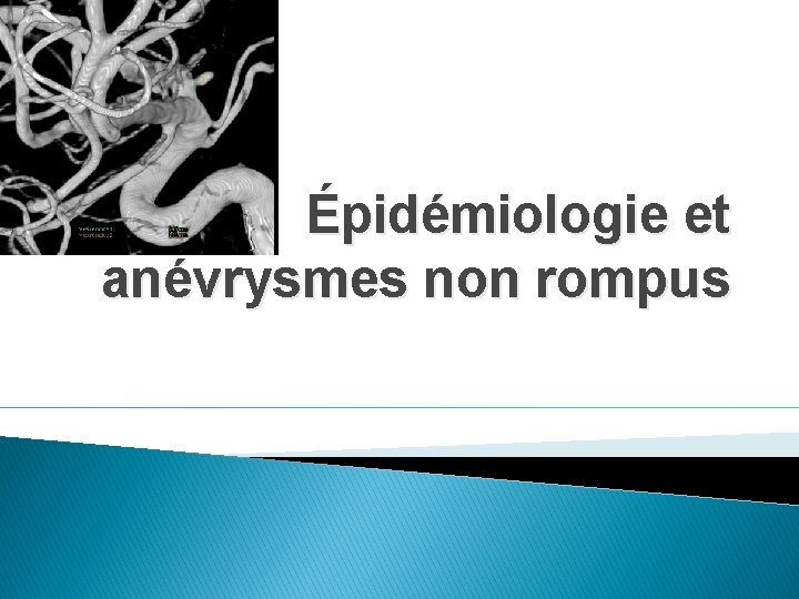 Épidémiologie et anévrysmes non rompus 