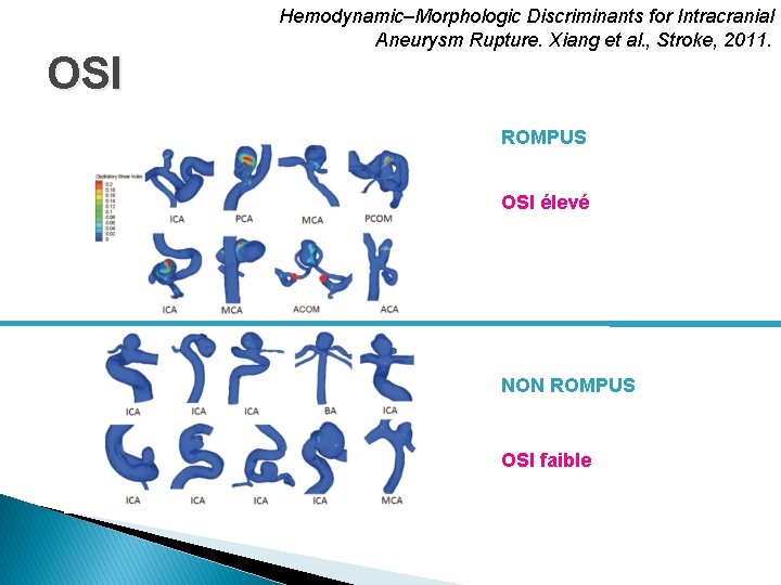 OSI Hemodynamic–Morphologic Discriminants for Intracranial Aneurysm Rupture. Xiang et al. , Stroke, 2011. ROMPUS