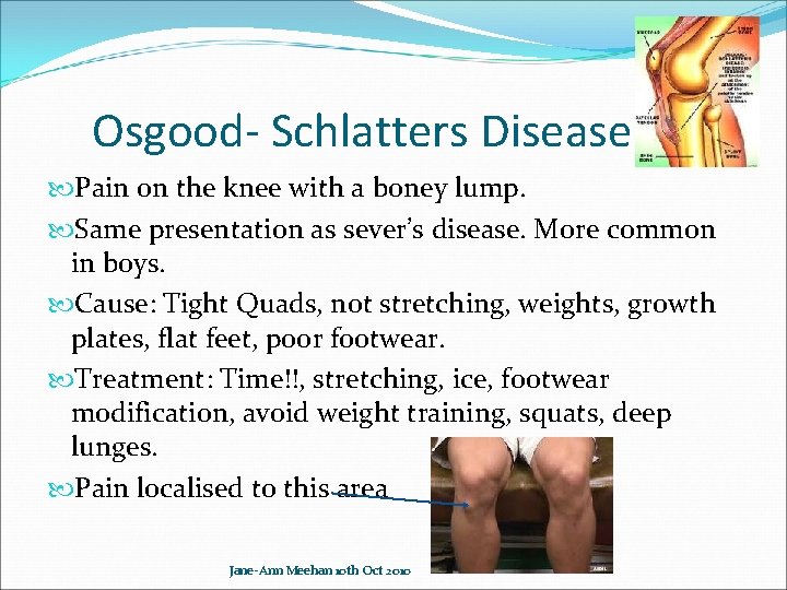 Osgood- Schlatters Disease Pain on the knee with a boney lump. Same presentation as