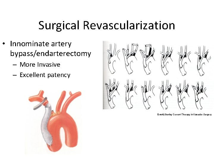 Surgical Revascularization • Innominate artery bypass/endarterectomy – More Invasive – Excellent patency Ernst&Stanley Current Surgical Revascularization • Innominate artery bypass/endarterectomy – More Invasive – Excellent patency Ernst&Stanley Current