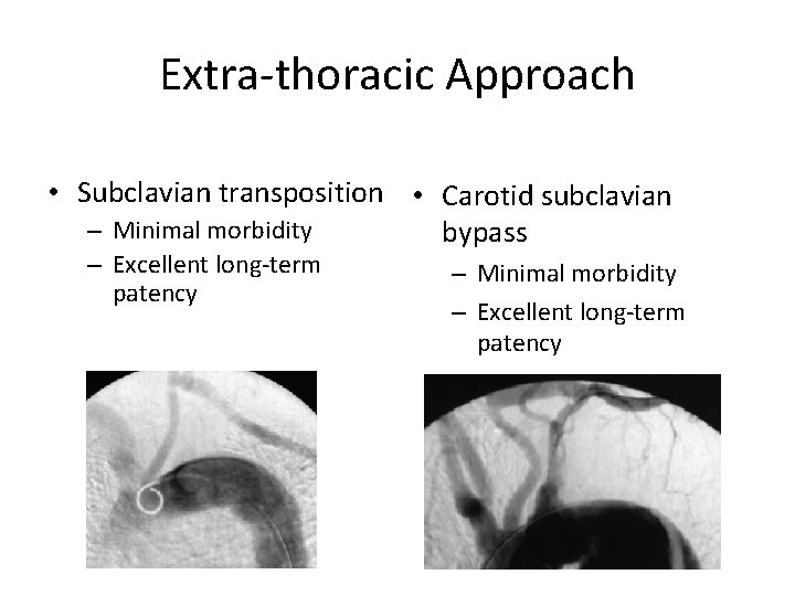 Extra-thoracic Approach • Subclavian transposition • Carotid subclavian – Minimal morbidity bypass – Excellent Extra-thoracic Approach • Subclavian transposition • Carotid subclavian – Minimal morbidity bypass – Excellent
