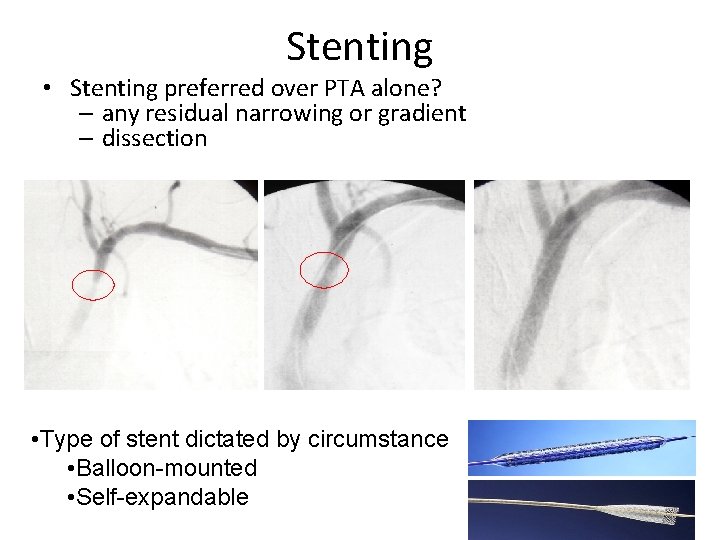Stenting • Stenting preferred over PTA alone? – any residual narrowing or gradient – Stenting • Stenting preferred over PTA alone? – any residual narrowing or gradient –