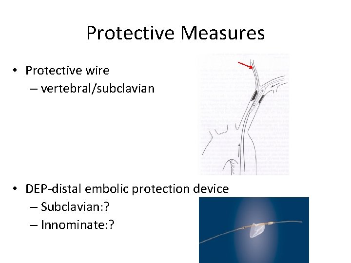 Protective Measures • Protective wire – vertebral/subclavian • DEP-distal embolic protection device – Subclavian: Protective Measures • Protective wire – vertebral/subclavian • DEP-distal embolic protection device – Subclavian: