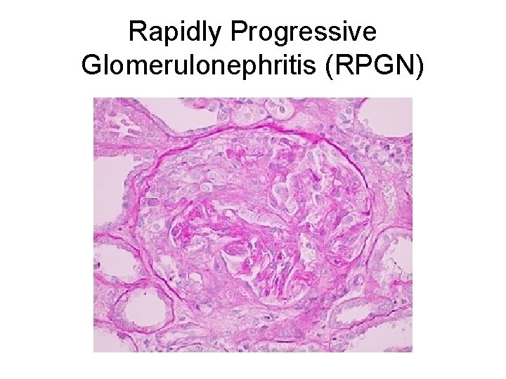 Rapidly Progressive Glomerulonephritis (RPGN) 