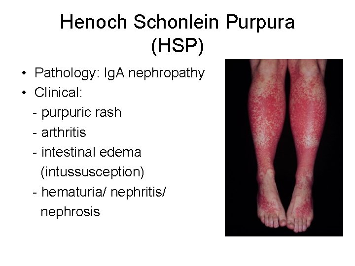 Henoch Schonlein Purpura (HSP) • Pathology: Ig. A nephropathy • Clinical: - purpuric rash