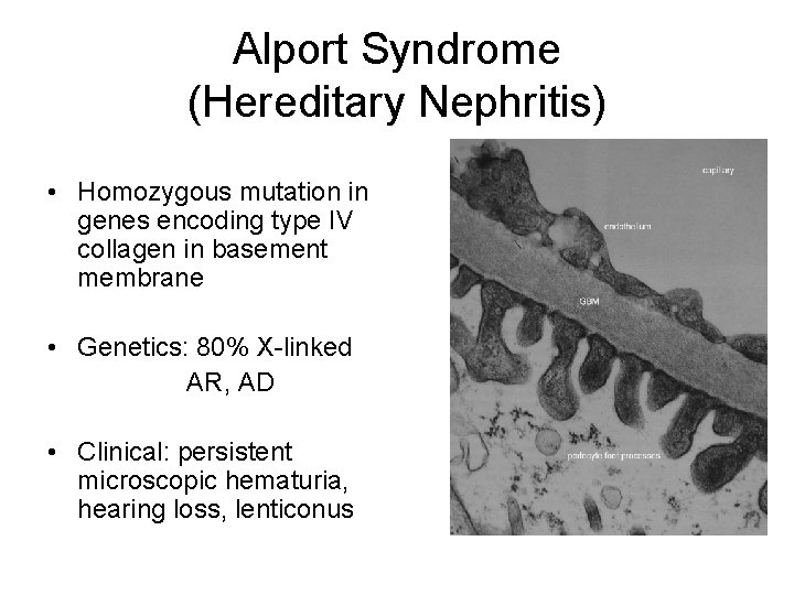 Alport Syndrome (Hereditary Nephritis) • Homozygous mutation in genes encoding type IV collagen in