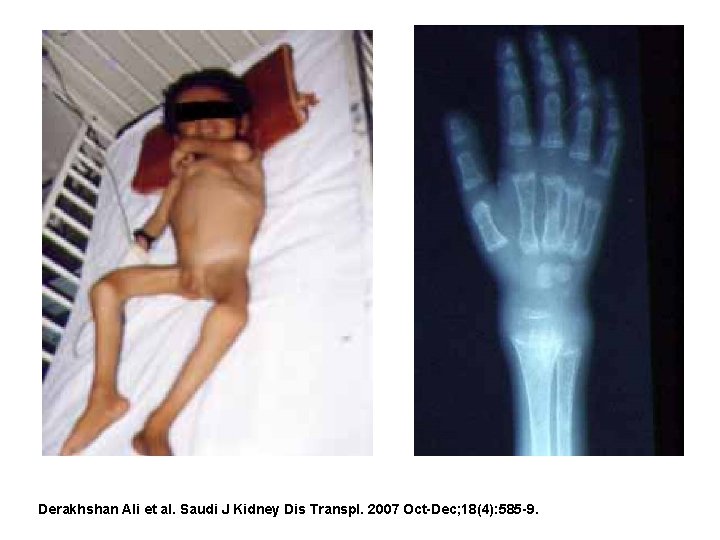 Derakhshan Ali et al. Saudi J Kidney Dis Transpl. 2007 Oct-Dec; 18(4): 585 -9.