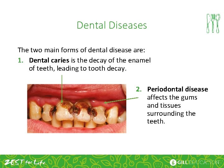 Dental Diseases The two main forms of dental disease are: 1. Dental caries is