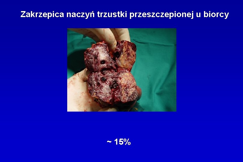 Zakrzepica naczyń trzustki przeszczepionej u biorcy ~ 15% 