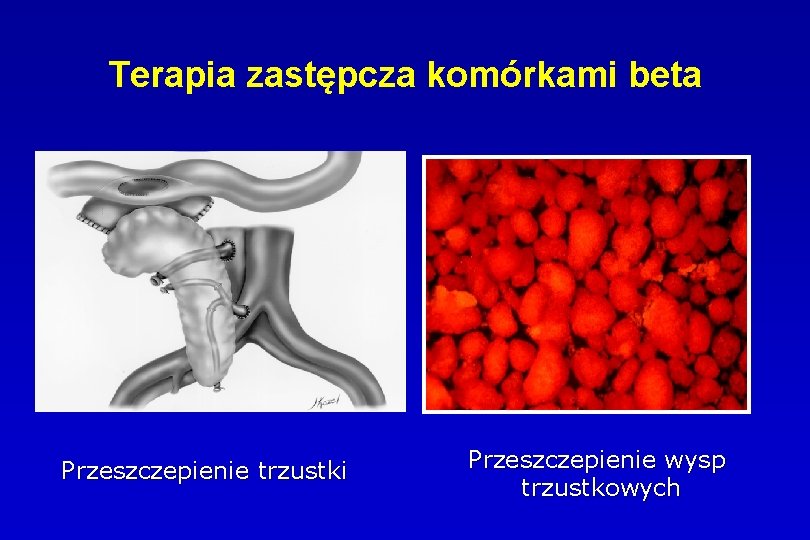 Terapia zastępcza komórkami beta Przeszczepienie trzustki Przeszczepienie wysp trzustkowych 