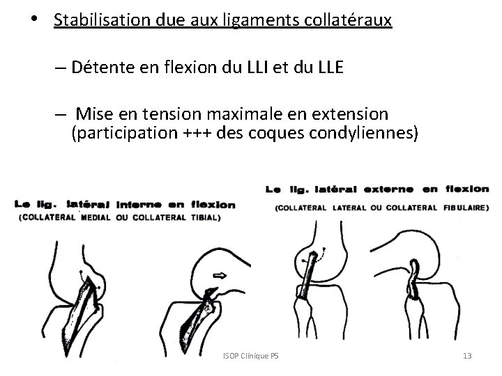  • Stabilisation due aux ligaments collatéraux – Détente en flexion du LLI et