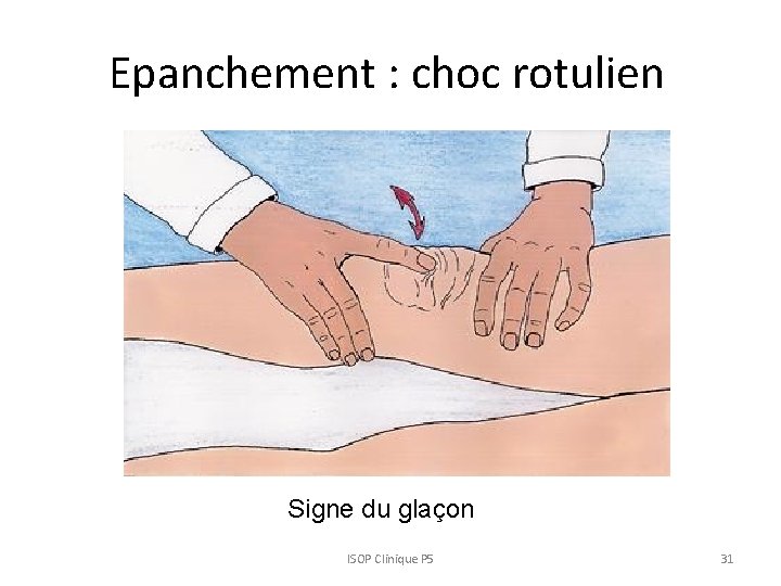 Epanchement : choc rotulien Signe du glaçon ISOP Clinique P 5 31 