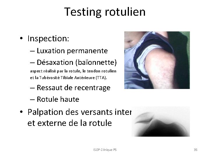 Testing rotulien • Inspection: – Luxation permanente – Désaxation (baïonnette) aspect réalisé par la