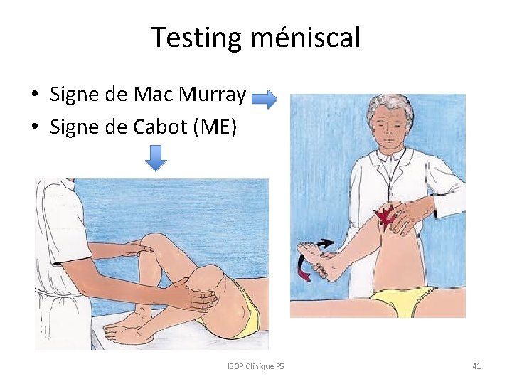 Testing méniscal • Signe de Mac Murray • Signe de Cabot (ME) ISOP Clinique