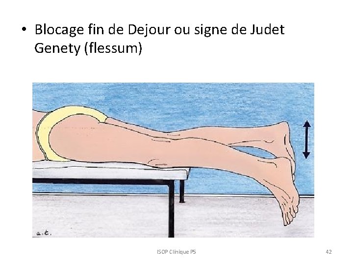  • Blocage fin de Dejour ou signe de Judet Genety (flessum) ISOP Clinique