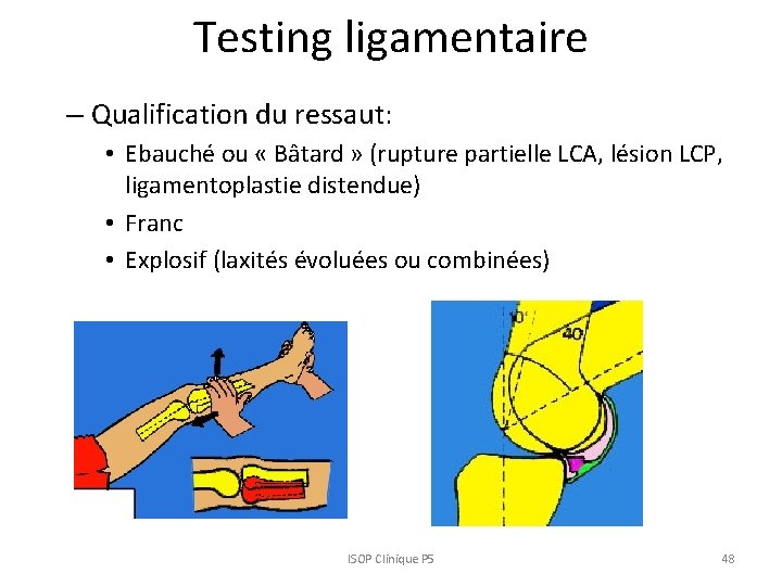 Testing ligamentaire – Qualification du ressaut: • Ebauché ou « Bâtard » (rupture partielle