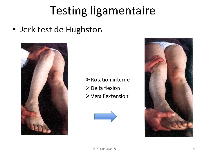 Testing ligamentaire • Jerk test de Hughston Ø Rotation interne Ø De la flexion