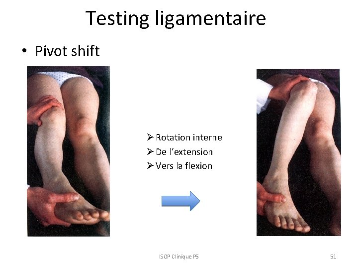 Testing ligamentaire • Pivot shift Ø Rotation interne Ø De l’extension Ø Vers la