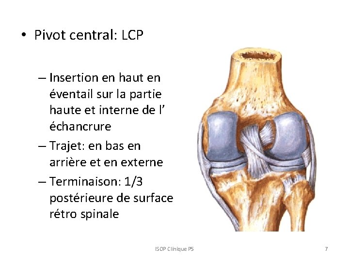  • Pivot central: LCP – Insertion en haut en éventail sur la partie